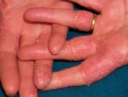 Contact Dermatitis