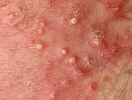 FOLLICULITIS