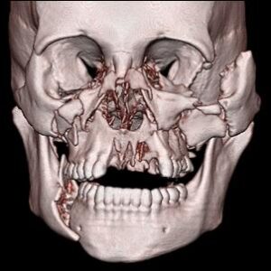 Facial-Injuries