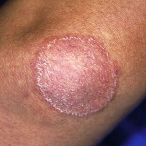 Fungal Infections