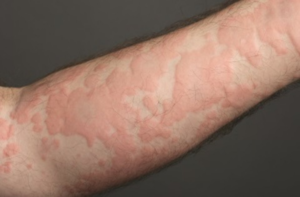 Hives