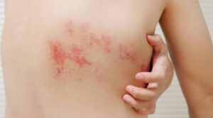 Herpes-zoster