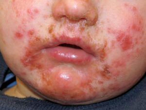 IMPETIGO