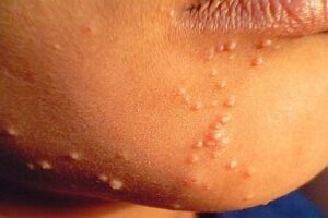 Molluscum_contagiosum