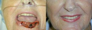 Orthoplasty