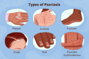PSORIASIS