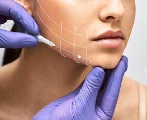 THREAD-LIFTS