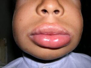 Urticaria