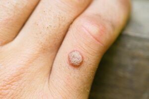 Viral-Warts