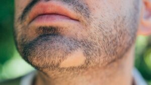 ALOPECIA AREATA (AA)