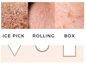 acne scar