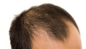 baldiness