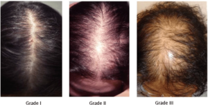 balding
