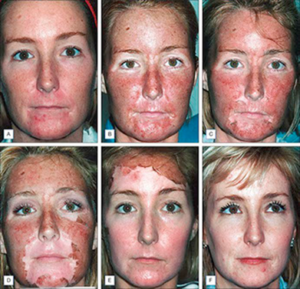 chemical-peel