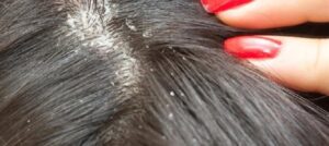 Dandruff