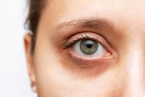 dark-circles