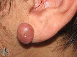 keloid