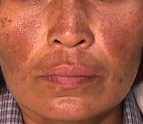melasma