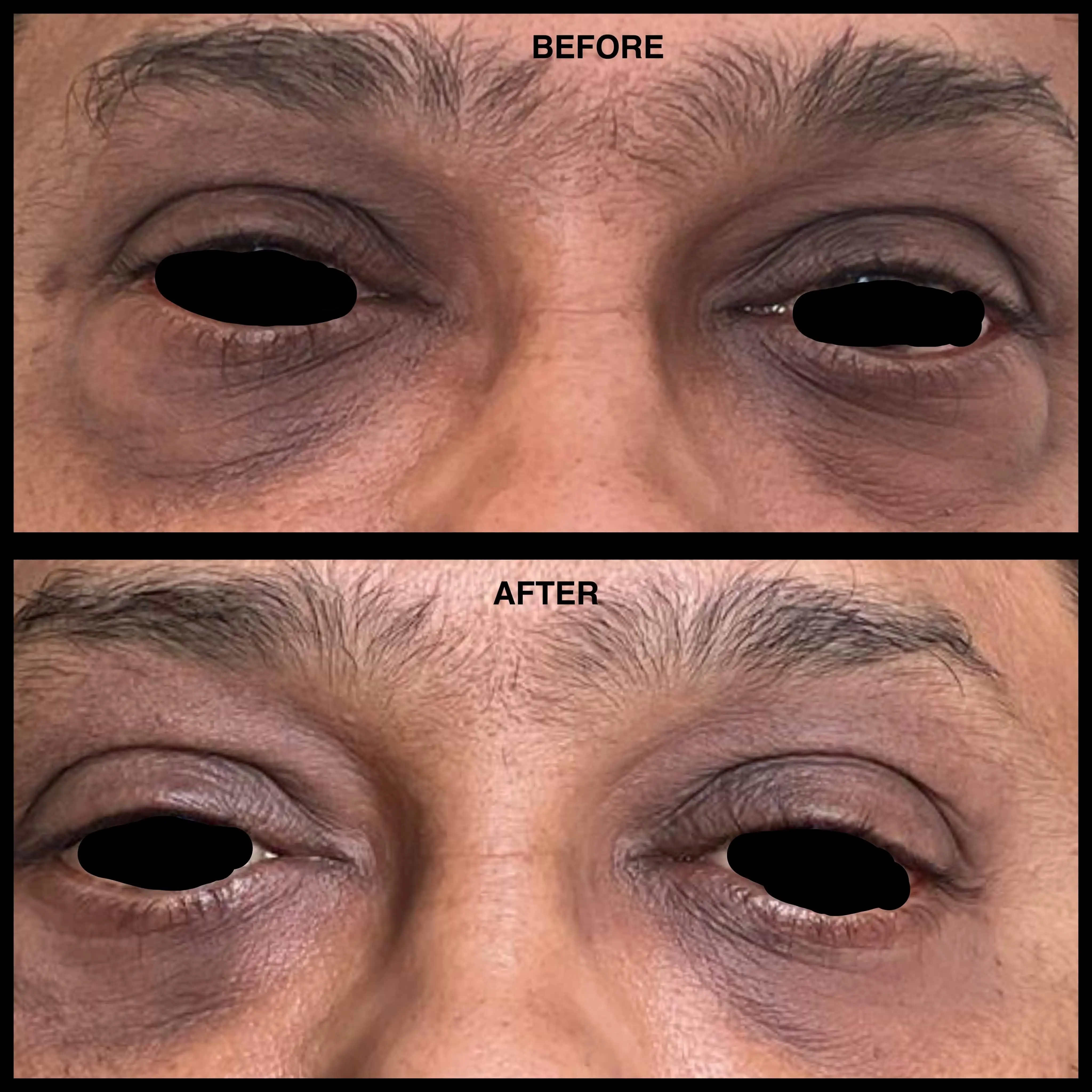Traumatic nasal reconstruction