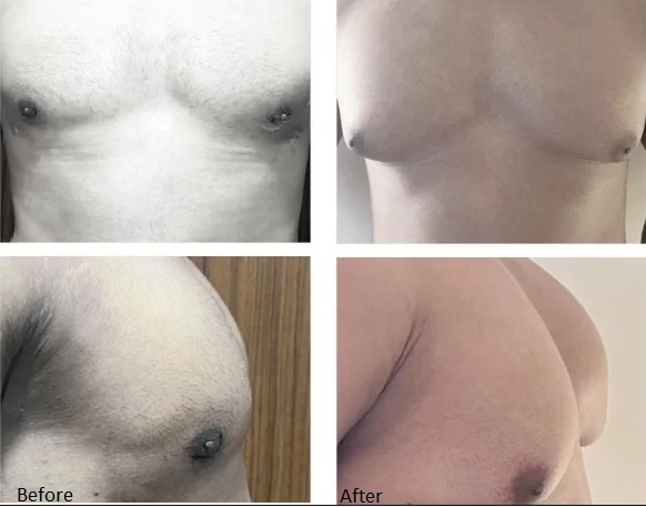 Gynaecomastia - liposuction