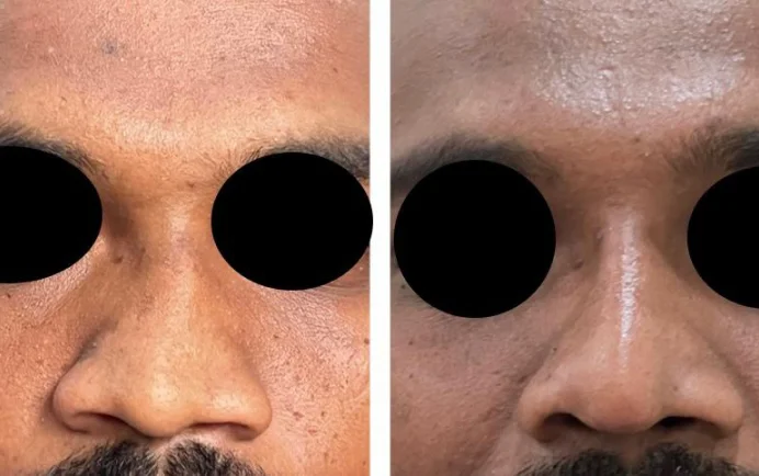 Rhinoplasty