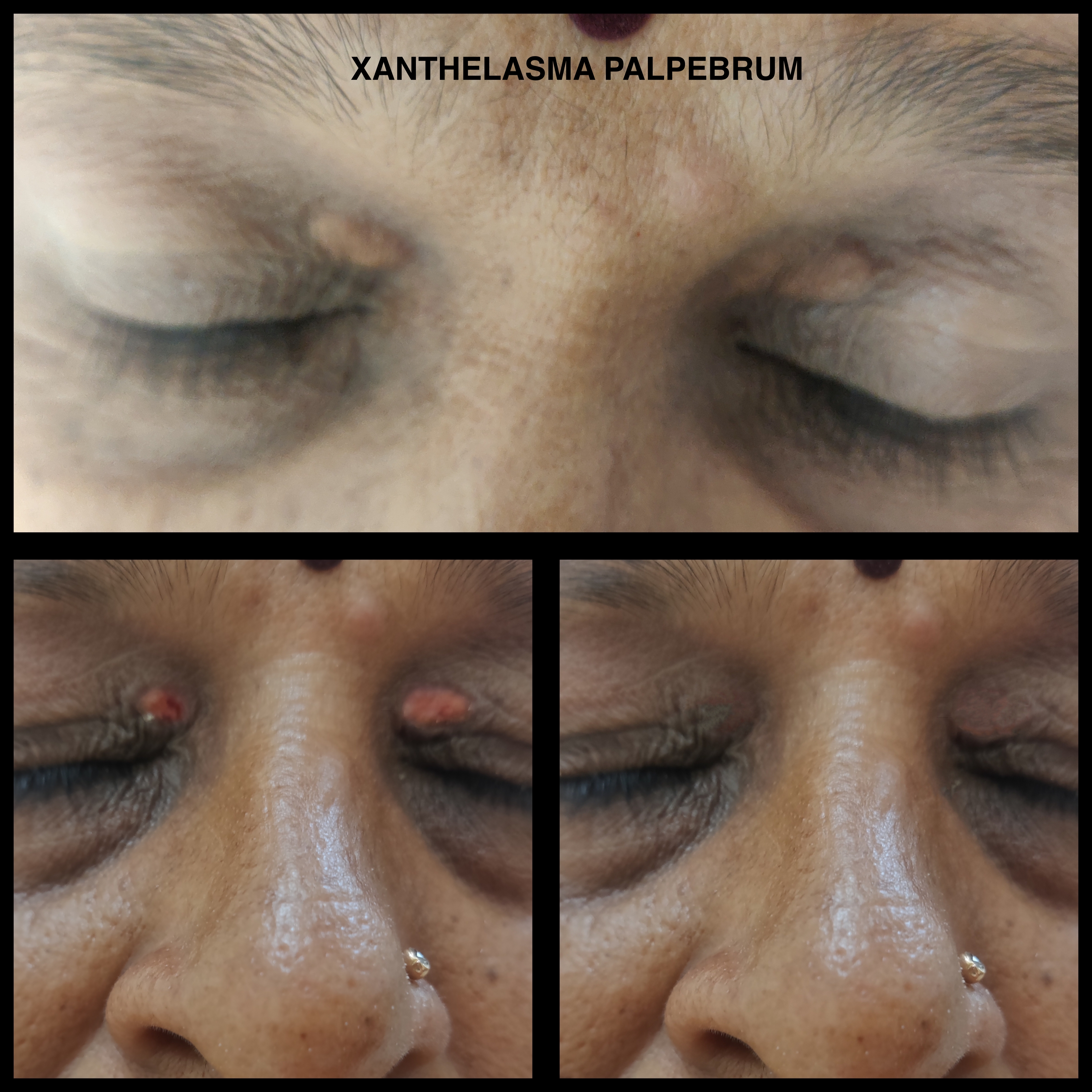 Traumatic nasal reconstruction