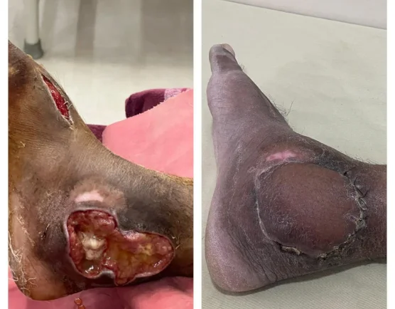 Diabetic foot reconstruction