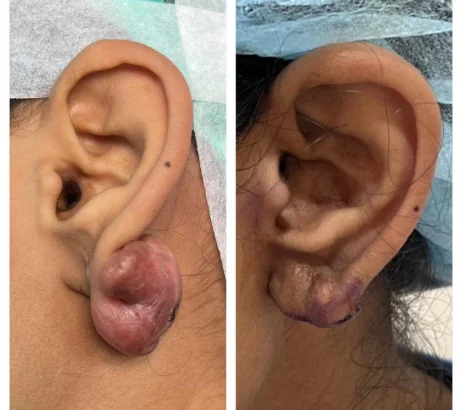 Keloid excision