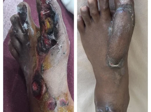 Traumatic foot reconstruction