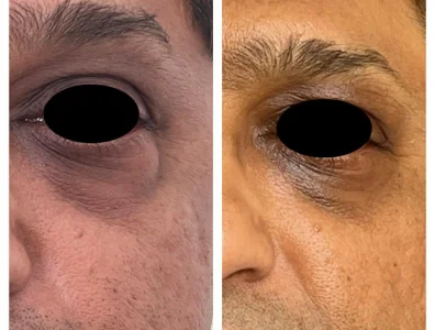Blepharoplasty