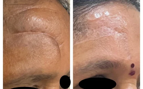 Depressed scar - scar revision