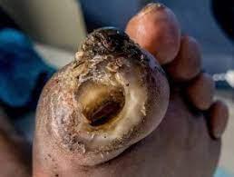Diabetic foot