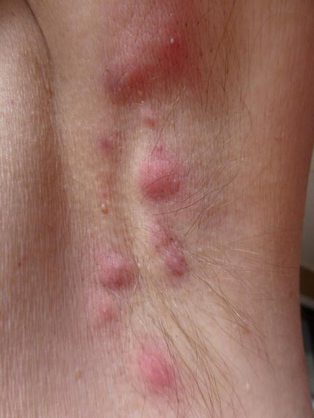 Hidradenitis suppurativa