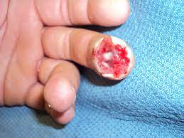 Traumatic Reconstruction