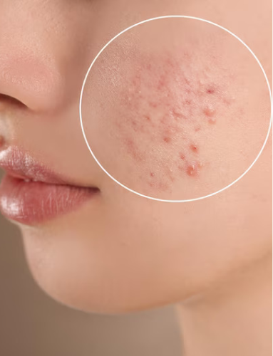 Acne, Acne scars & Pigmentation Treatment in Bangalore