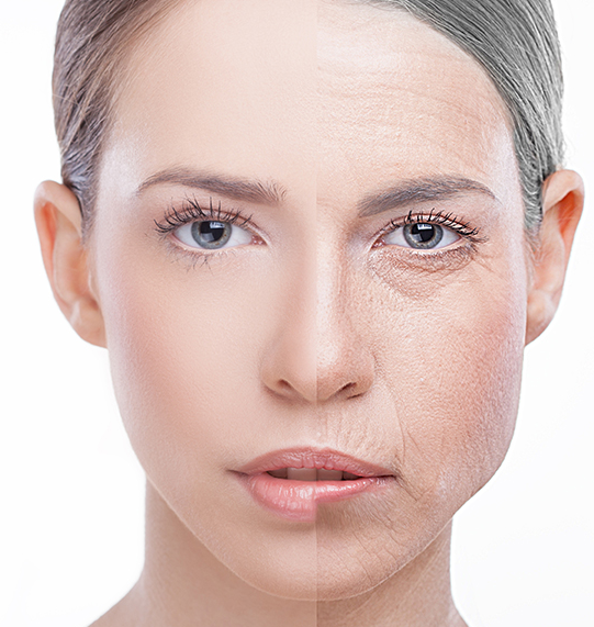 Facelift