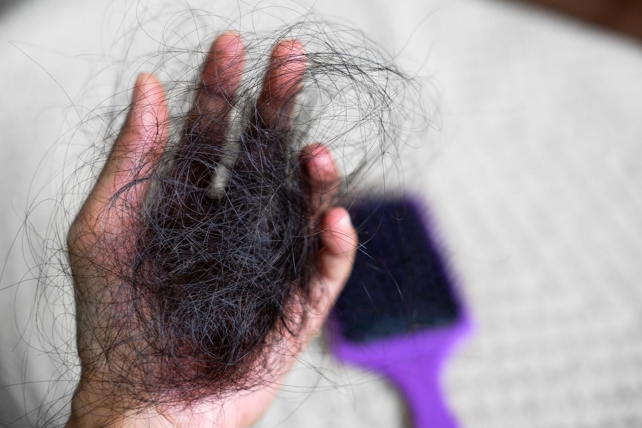 Hairloss