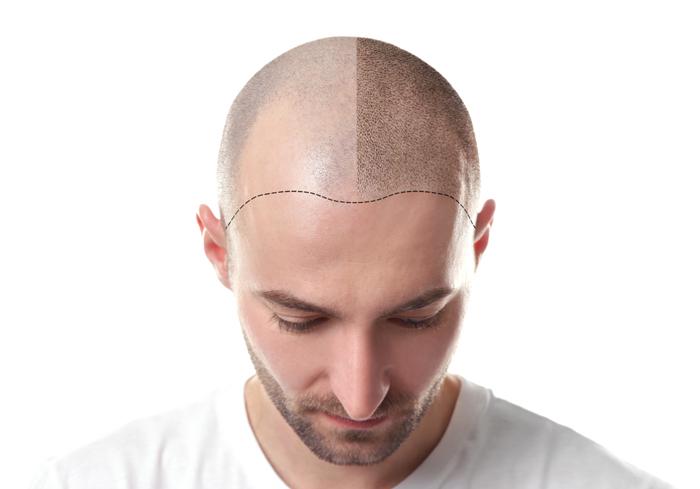 Hair transplantation