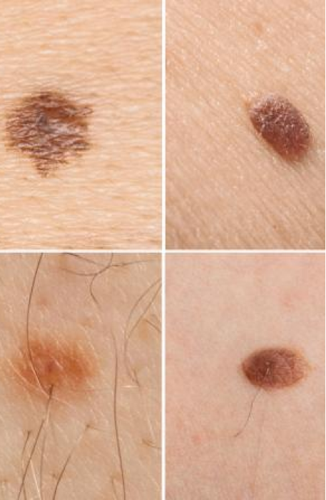Moles/Birthmarks