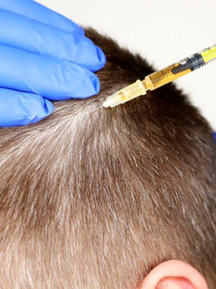 PRP Treatment | GFC Treatment in BTM Bangalore