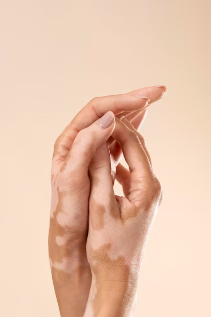 Vitiligo | Psoriasis Treatment in BTM Bangalore