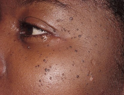 DPNs & Keloids/ Hypertrophic scars